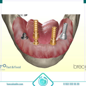 SKY (Bredent) implant