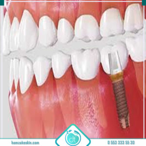 Osstem İmplant