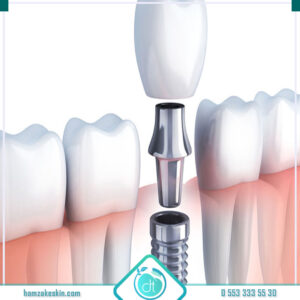 Gaziosmanpaşa implant diş fiyatları
